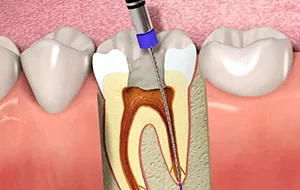 About root canal treatment