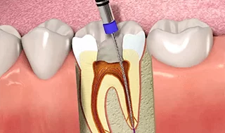 Root Canal Treatment