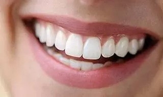 Porcelain dental veneer