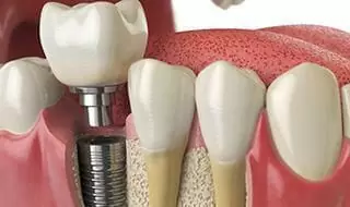 implant 1024x768 1