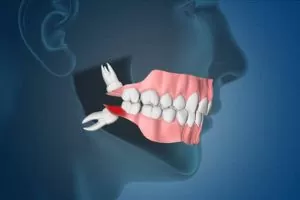 Extraction of Impacted Wisdom Teeth
