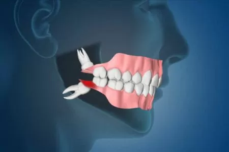 wisdom teeth Good Samaritan Dental Implant Institute